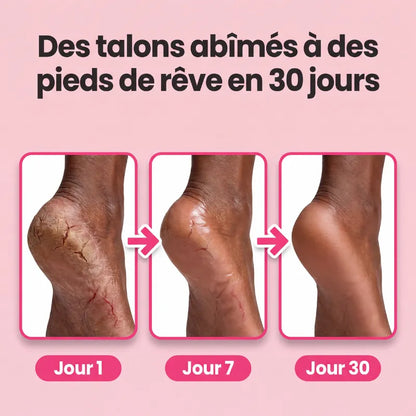 TalonPro — Râpe Anti-Callosités
